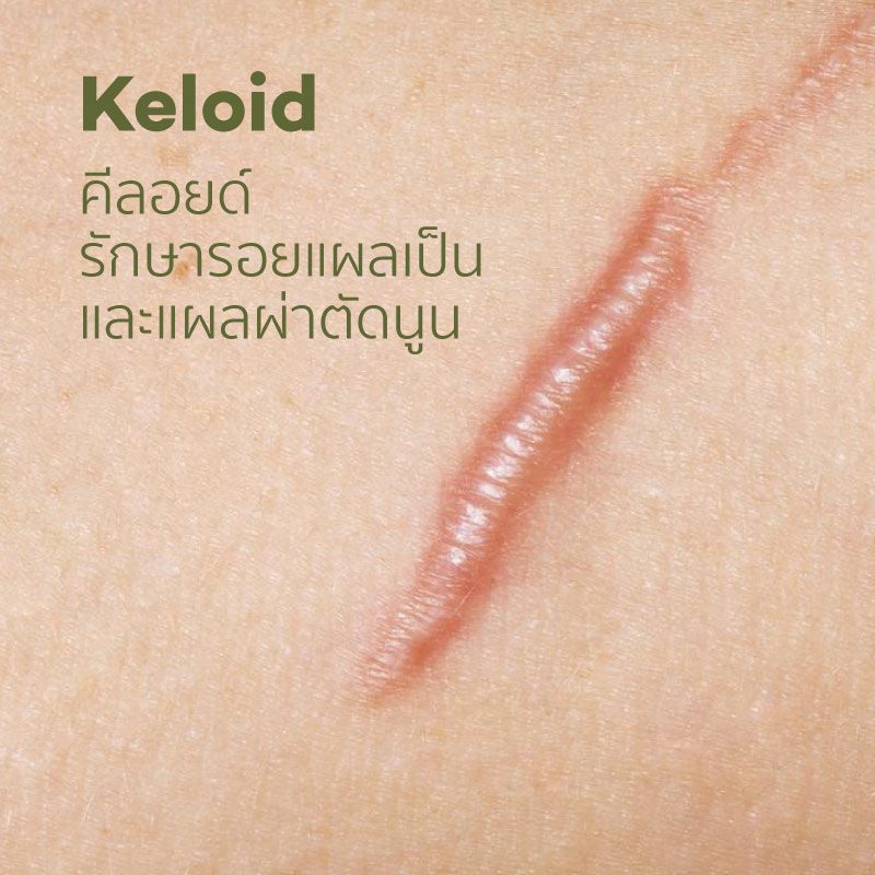 CC_services_Keloid